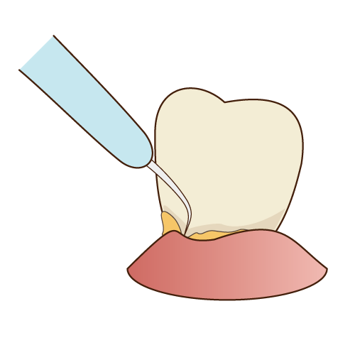歯周病治療は歯垢・歯石除去が大事になります。