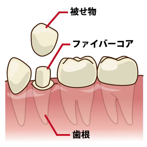 宝塚でファイバーコアを使用した審美歯科治療なら安福歯科医院