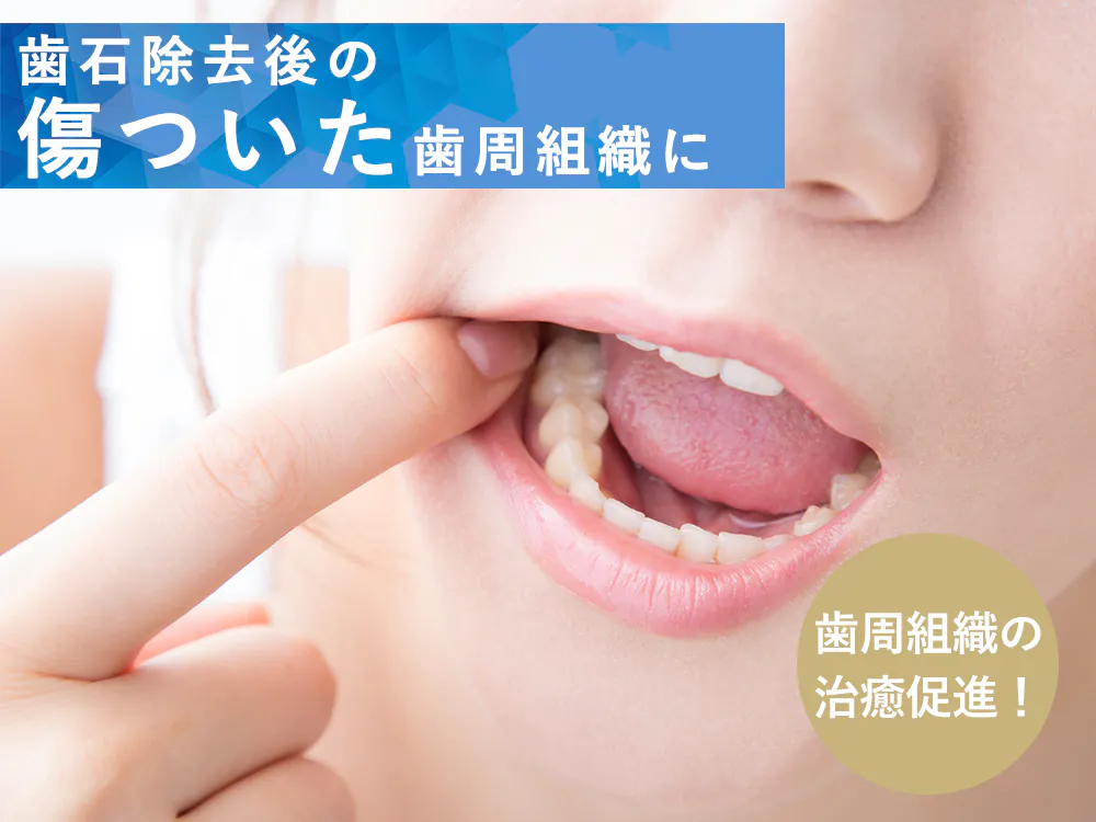 歯石除去後の歯周組織の治癒促進