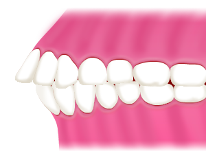 口ゴボ くちごぼ を治したい 口ゴボの矯正 宝塚の安福歯科医院
