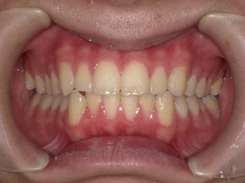 前歯の矯正症例before